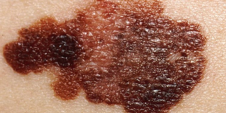 Melanoma. / Foto: Wikipedia.