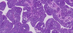 Alteraciones genéticas de cáncer renal infantil.