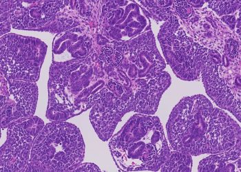 Alteraciones genéticas de cáncer renal infantil.