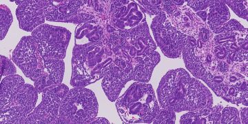 Alteraciones genéticas de cáncer renal infantil.