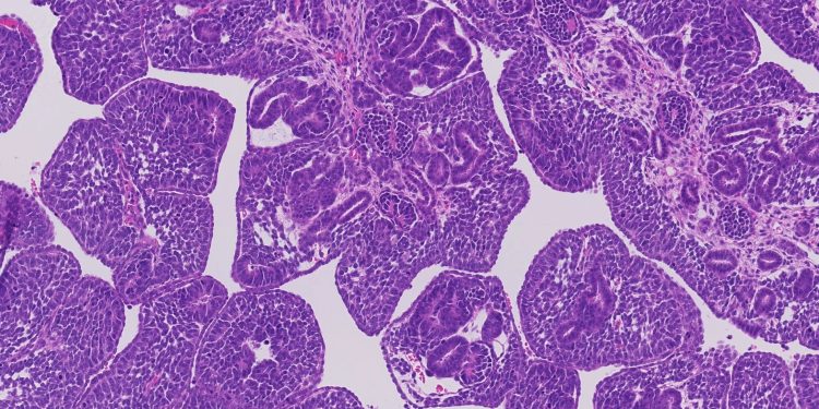 Alteraciones genéticas de cáncer renal infantil.