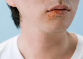 Según estudio, el herpes labial está asociado con la enfermedad de Alzheimer. /Foto: tomado de Heraldo, en línea