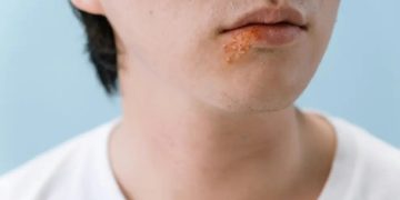 Según estudio, el herpes labial está asociado con la enfermedad de Alzheimer. /Foto: tomado de Heraldo, en línea