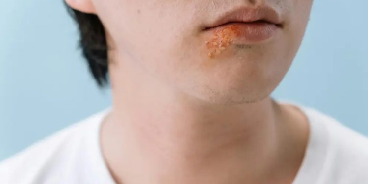 Según estudio, el herpes labial está asociado con la enfermedad de Alzheimer. /Foto: tomado de Heraldo, en línea