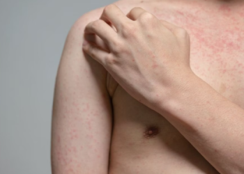 Ministerio de Salud comparte medidas para la prevención del sarampión. (Foto: archivo)