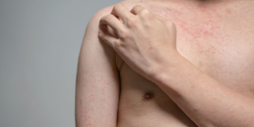 Ministerio de Salud comparte medidas para la prevención del sarampión. (Foto: archivo)