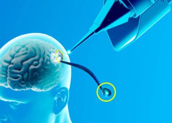 Los pacientes que acceden a probar chips cerebrales lo hacen con la esperanza de mejorar su condición.