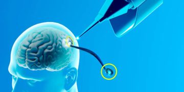 Los pacientes que acceden a probar chips cerebrales lo hacen con la esperanza de mejorar su condición.