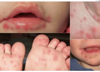 La transmisión ocurre a través de secreciones respiratorias, saliva, líquido de las ampollas, heces o por contacto con objetos contaminados, como cubiertos y juguetes. / Foto: MSPAS