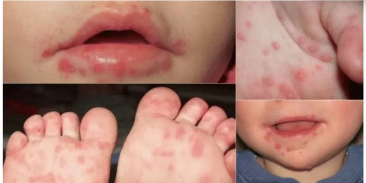 La transmisión ocurre a través de secreciones respiratorias, saliva, líquido de las ampollas, heces o por contacto con objetos contaminados, como cubiertos y juguetes. / Foto: MSPAS