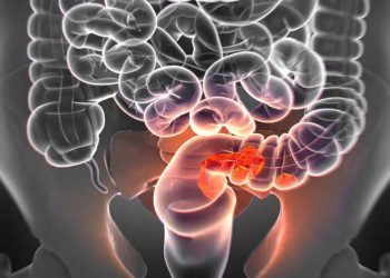 El cáncer colorrectal se diagnostica en menores de 50 años suele detectarse en fases avanzadas.