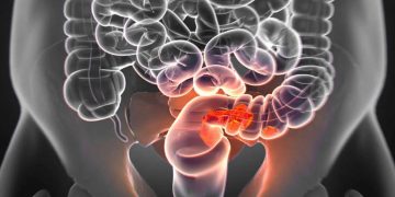 El cáncer colorrectal se diagnostica en menores de 50 años suele detectarse en fases avanzadas.