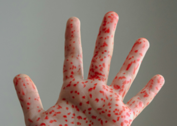 El sarampión es una enfermedad muy contagiosa, que se puede prevenir con la vacuna. (Foto: Unsplash)