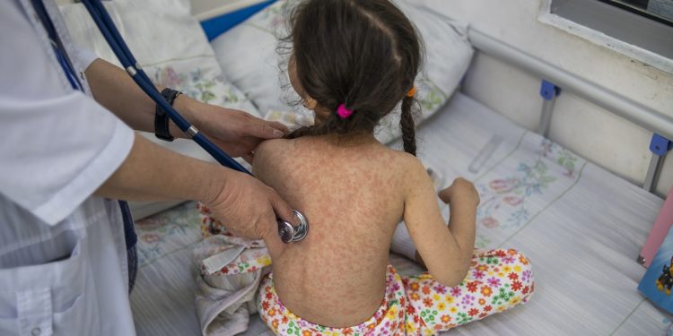 Imagen con fines ilustrativos del sarampión. / Foto: OMS.