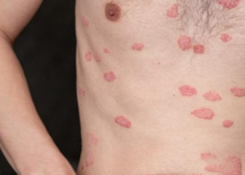 Especialista comparte recomendaciones ante la enfermedad tropical “Leishmaniasis”. (Foto : MSPAS)