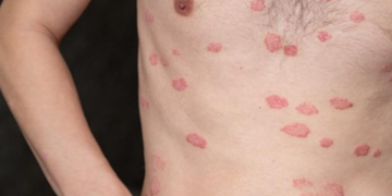 Especialista comparte recomendaciones ante la enfermedad tropical “Leishmaniasis”. (Foto : MSPAS)