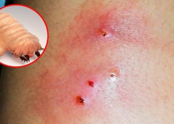 La mosca deposita sus huevesillos en heridas de animales o humanos y estos se convierten en larvas que se alimentan de tejido vivo.