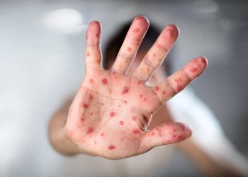 El Ministerio de Salud sigue reforzando las acciones estratégicas para el abordaje del sarampión a nivel nacional y departamental. (Foto: archivo)