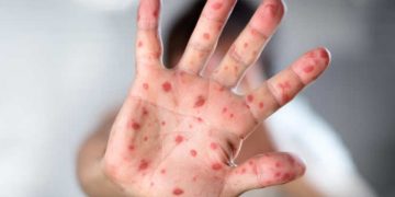 El Ministerio de Salud sigue reforzando las acciones estratégicas para el abordaje del sarampión a nivel nacional y departamental. (Foto: archivo)