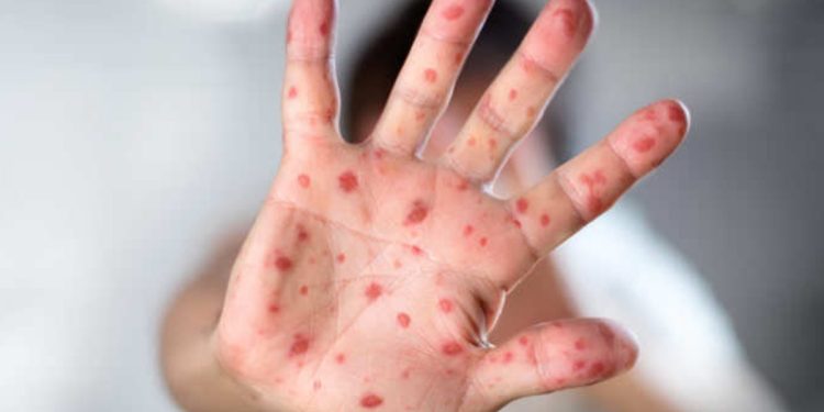 El Ministerio de Salud sigue reforzando las acciones estratégicas para el abordaje del sarampión a nivel nacional y departamental. (Foto: archivo)