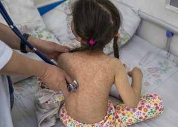 MSPAS intensifica acciones contra brote de sarampión./Foto: OMS.