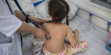 MSPAS intensifica acciones contra brote de sarampión./Foto: OMS.
