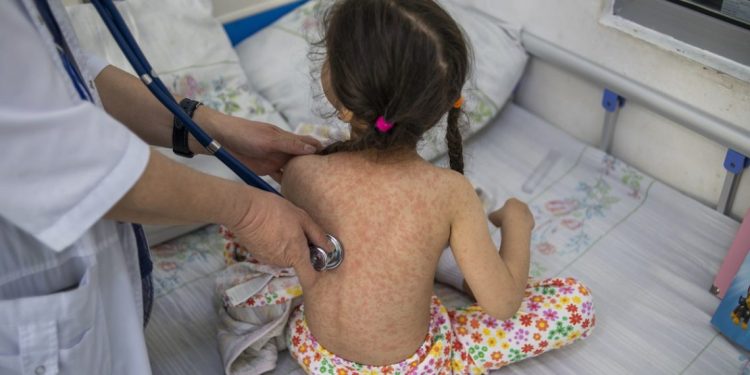 MSPAS intensifica acciones contra brote de sarampión./Foto: OMS.