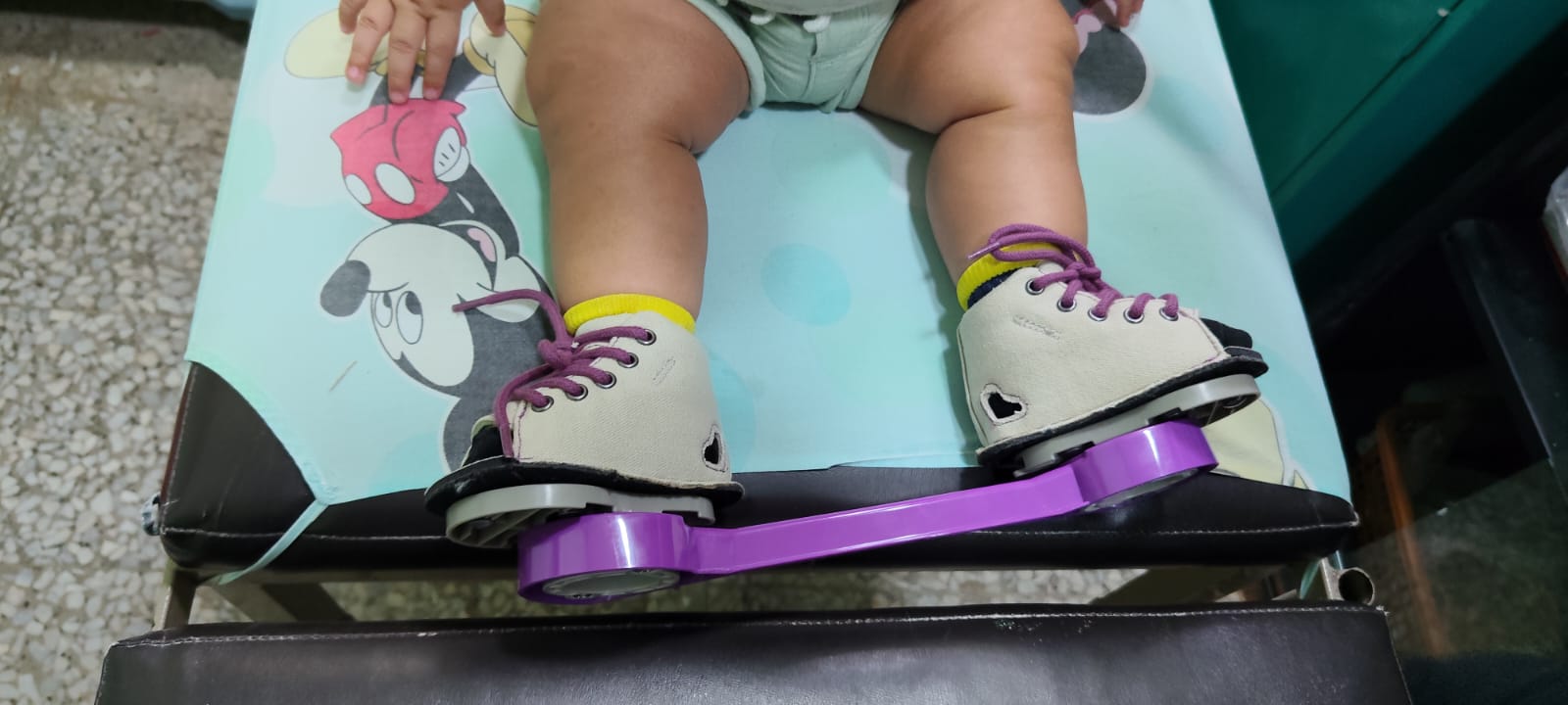 Detalle de los pies de un niño con calzado especializado unido por una barra morada, sobre una camilla.