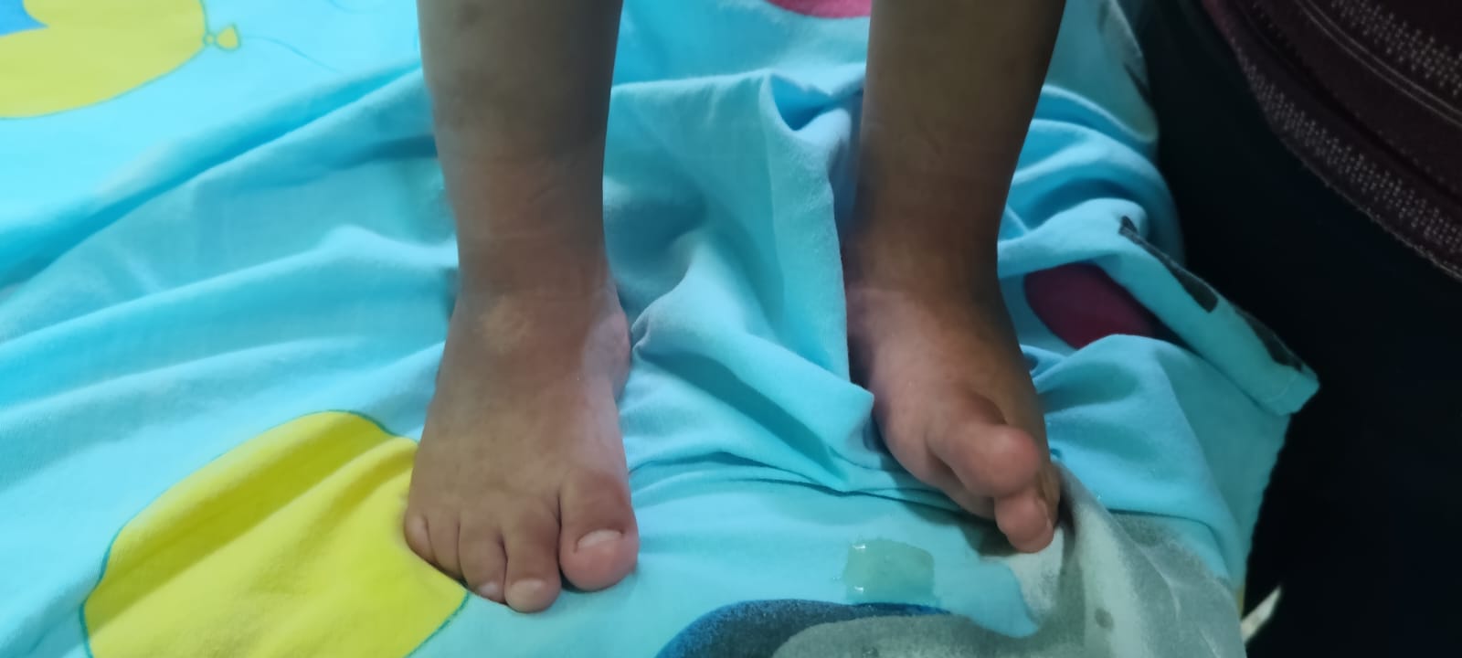 Detalle de los pies de un paciente infantil sobre una camilla; uno de ellos presenta una inclinación hacia adentro.